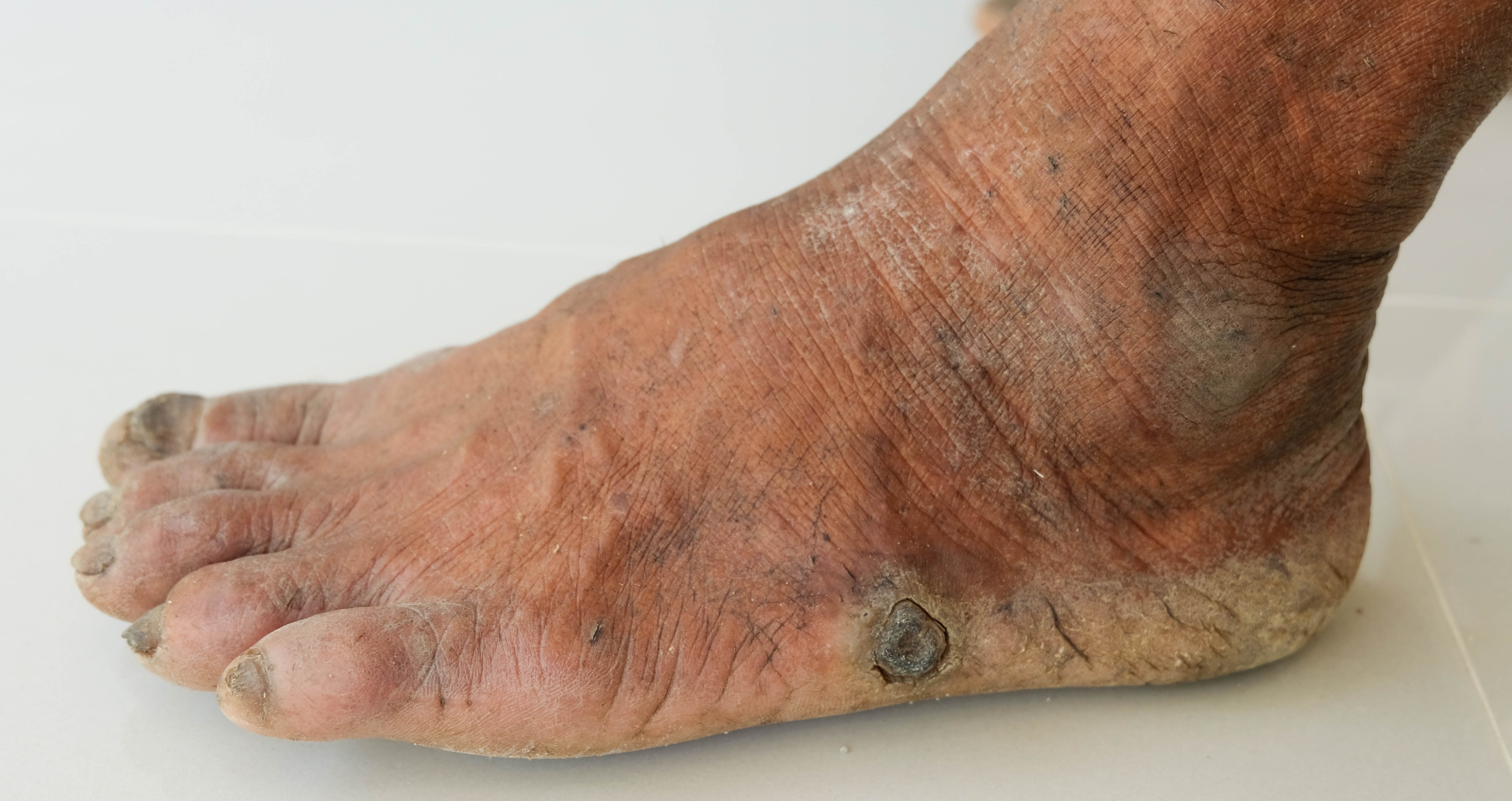 Photo of diabetic foot